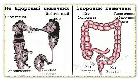 дисбактериоз кишечника у ЧБД
